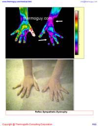 Reflex Sympathetic Dystrophy Imaging