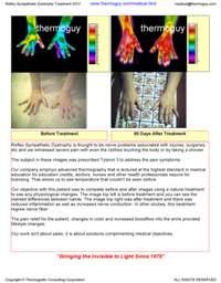 Reflex Sympathetic Dystrophy Imaging & Treatment