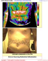 Chrohn's Disease, Colitis, Irritable Bowel Inflammation Can Be Seen