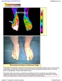 Recurring Foot Ulcers of Unknown Origin