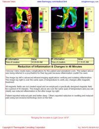 Varicose Veins & Leg Inflammation Can Be Seen